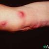 sporotrichosis-on-the-arm
