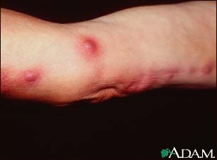 sporotrichosis-on-the-arm